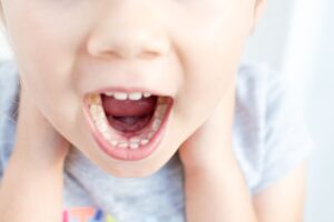 &ldquo;Shark teeth&rdquo; in child&rsquo;s lower dental arch 